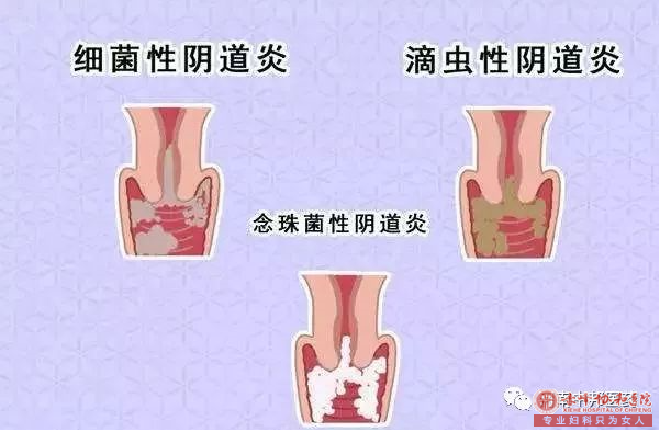 选择金华哪家医院治阴道炎好?