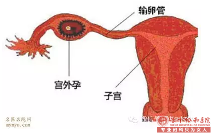 金华红山区华山医院治疗宫外孕多少钱?