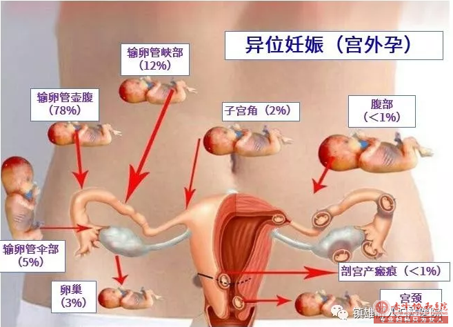 金华敖汉旗宫外孕的早期症状是什么？试纸能测出吗？
